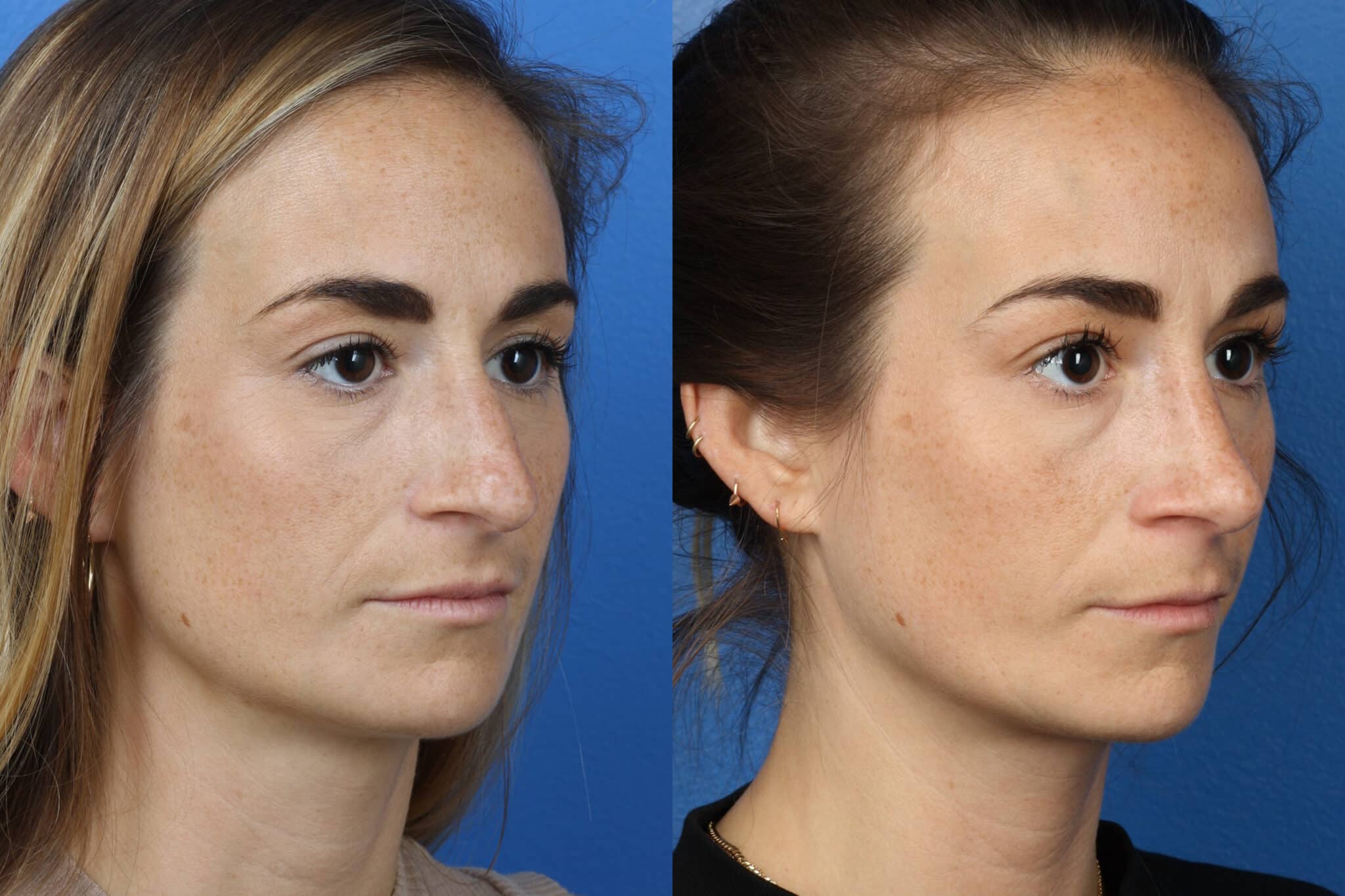 Rhinoplasty to correct the nasal bridge and tip of a female patient by Dr. Miller. Surgery creates a more feminine slope to the nose and slightly rotates the tip.
