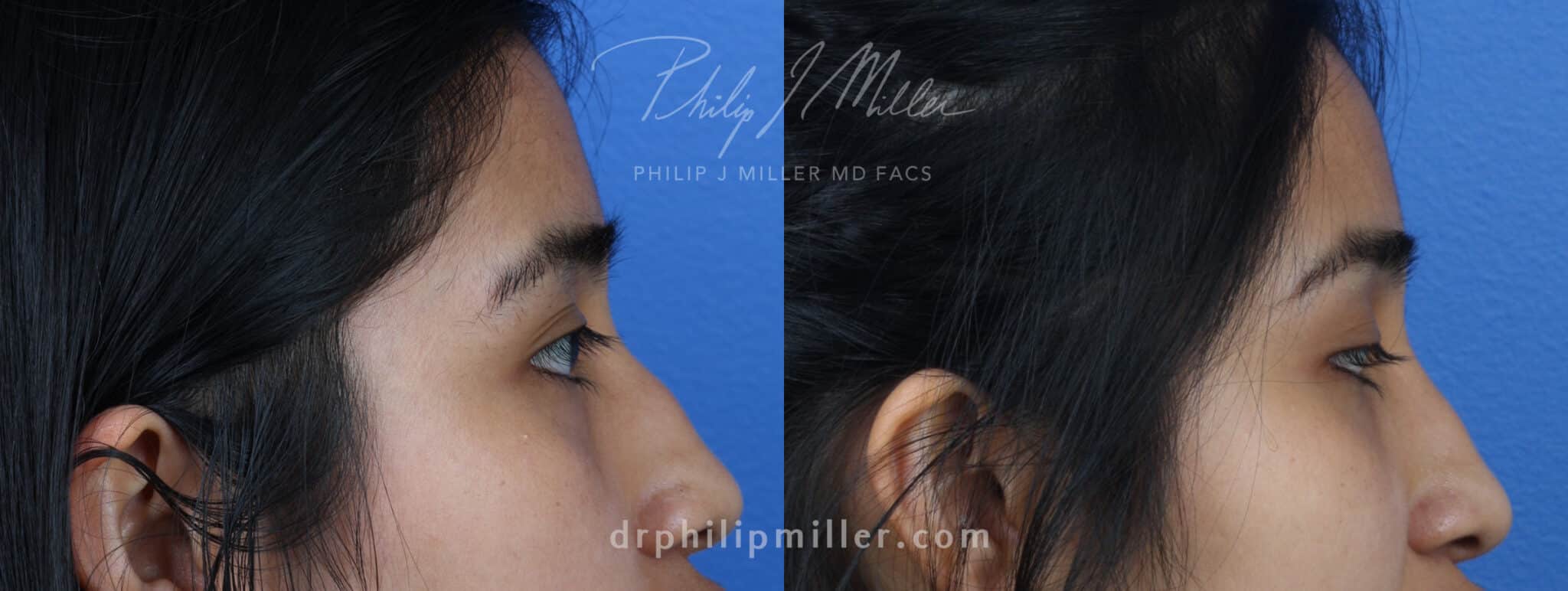 Rhinoplasty to correct the nasal bridge of a female patient by Dr. Miller. Surgery straightens bridge and removes bump to improve the patient's profile.