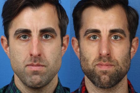 Rhinoplasty to Straighten Nasal Bridge of a Male Patient by Dr. Miller