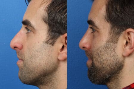 Rhinoplasty to Correct Nasal Bridge by Dr. Miller