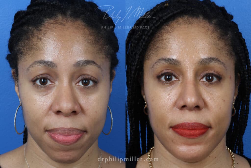 Rhinoplasty, upper blepharoplasty, chin implant, and fat grafting for facial contouring of a female patient by Dr. Miller. Treatments bring facial features in proportion to improve the facial contour.