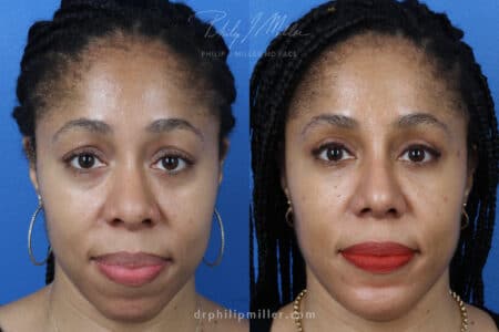 Rhinoplasty Upper Blepharoplasty Chin Implant and Fat Grafting for Facial Contouring of a Female Patient by Dr. Miller