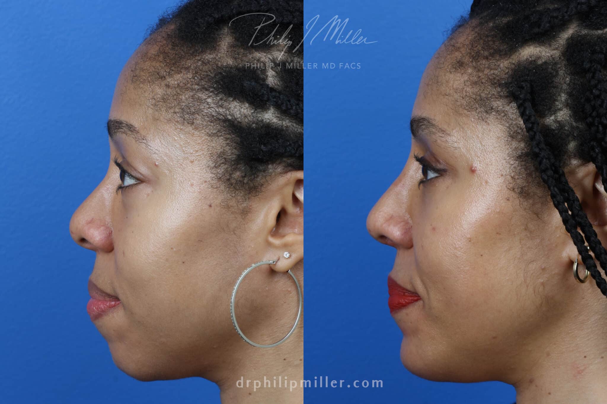 Rhinoplasty, upper blepharoplasty, chin implant, and fat grafting for facial contouring of a female patient by Dr. Miller. Surgery creates proportion of the features to dramatically improve the patient's profile.