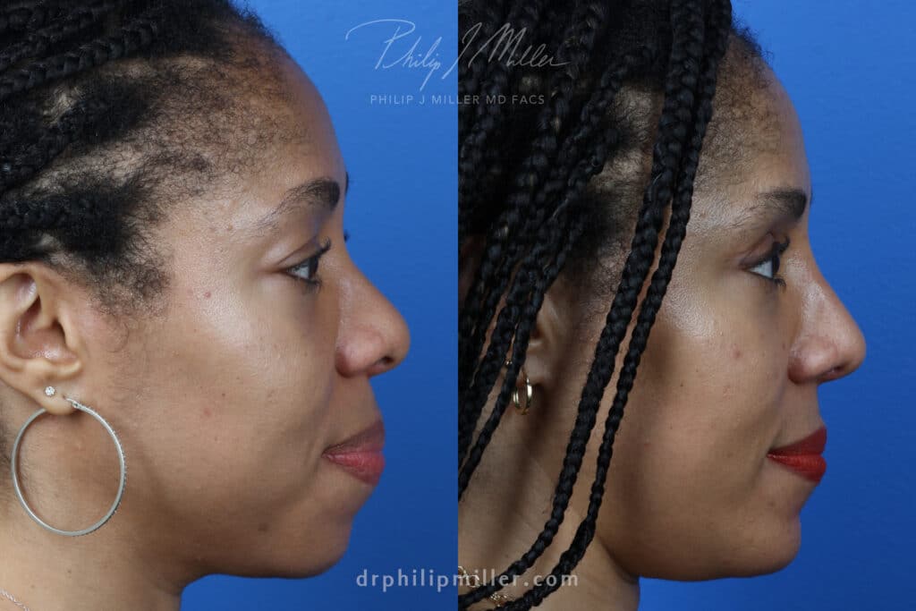 Rhinoplasty, upper blepharoplasty, chin implant, and fat grafting for facial contouring of a female patient by Dr. Miller. Procedures dramatically enhance patient's facial profile.