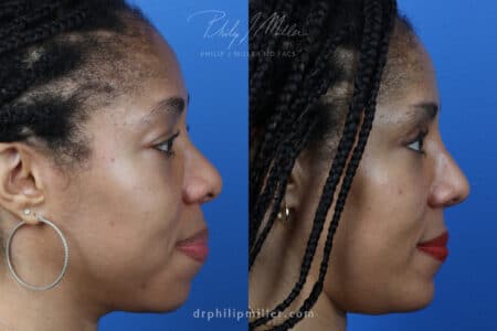 Rhinoplasty, Upper Blepharoplasty, Chin Implant, Fat Injections for Facial Contouring on a Female Patient by Dr. Miller.