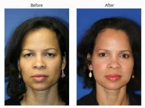 before and after of a forehead lift in new york city