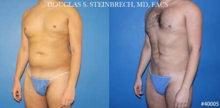 Body banking with liposuction to sculpt midsection and buttocks by Dr. Steinbrech