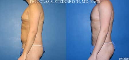 Body banking with liposuction to sculpt midsection and buttocks by Dr. Steinbrech