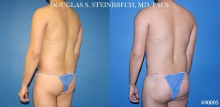 Body banking with liposuction to sculpt midsection and buttocks by Dr. Steinbrech