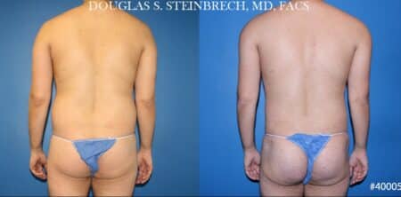 Body banking with liposuction to sculpt midsection and buttocks by Dr. Steinbrech