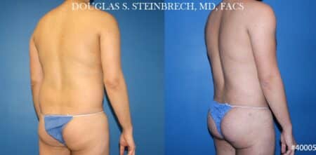 Body banking with liposuction to sculpt midsection and buttocks by Dr. Steinbrech