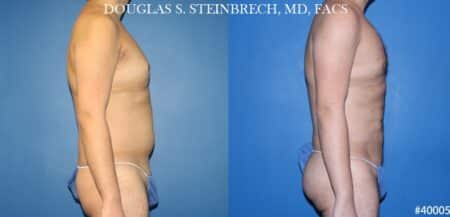 Body banking with liposuction to sculpt midsection and buttocks by Dr. Steinbrech