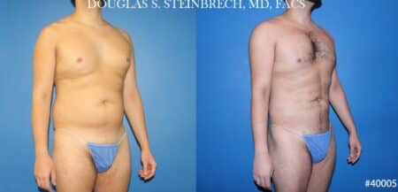 Body banking with liposuction to sculpt midsection and buttocks by Dr. Steinbrech