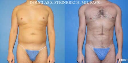 Body banking with liposuction to sculpt midsection and buttocks by Dr. Steinbrech