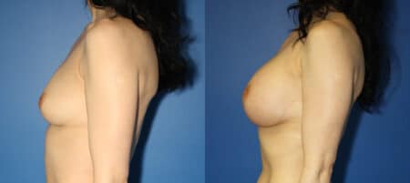 Breast implants to increase breast size by Dr. Steinbrech