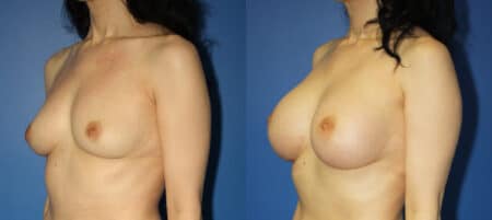 Breast implants to increase breast size by Dr. Steinbrech