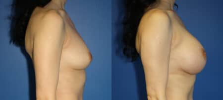 Breast implants to increase breast size by Dr. Steinbrech