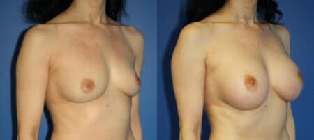 Breast implants to increase breast size by Dr. Steinbrech