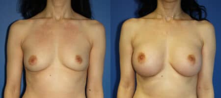 Breast implants to increase breast size by Dr. Steinbrech