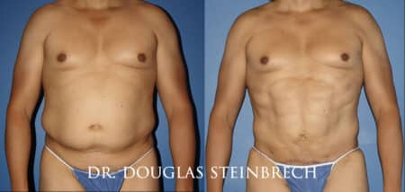 Torso tuck to reduce excess fat and sculpt the midsection by Dr. Steinbrech