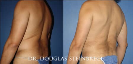 Torso tuck to reduce excess fat and sculpt the back and waistline by Dr. Steinbrech