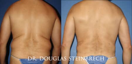 Torso tuck to reduce excess fat and sculpt the back and waistline by Dr. Steinbrech