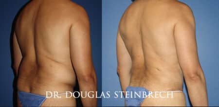 Torso tuck to reduce excess fat and sculpt the back and waistline by Dr. Steinbrech