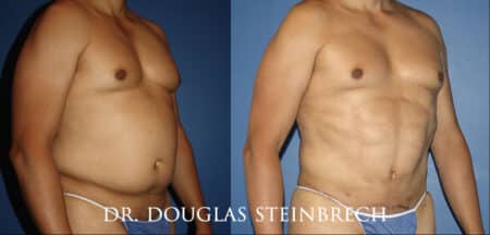 Torso tuck to reduce excess fat and sculpt the midsection by Dr. Steinbrech