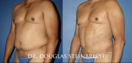 Torso tuck to reduce excess fat and sculpt the midsection by Dr. Steinbrech