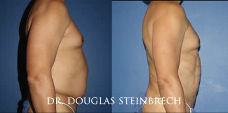 Torso tuck to reduce excess fat and sculpt the midsection by Dr. Steinbrech