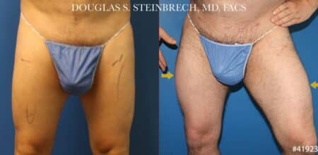 Quad augmentation to enlarge thighs by Dr. Steinbrech