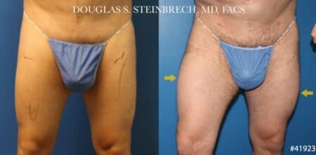 Quad augmentation to enlarge thighs by Dr. Steinbrech