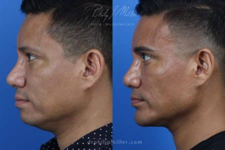 Neck-Tite and Liposuction to Contour the Neck by Dr. Miller