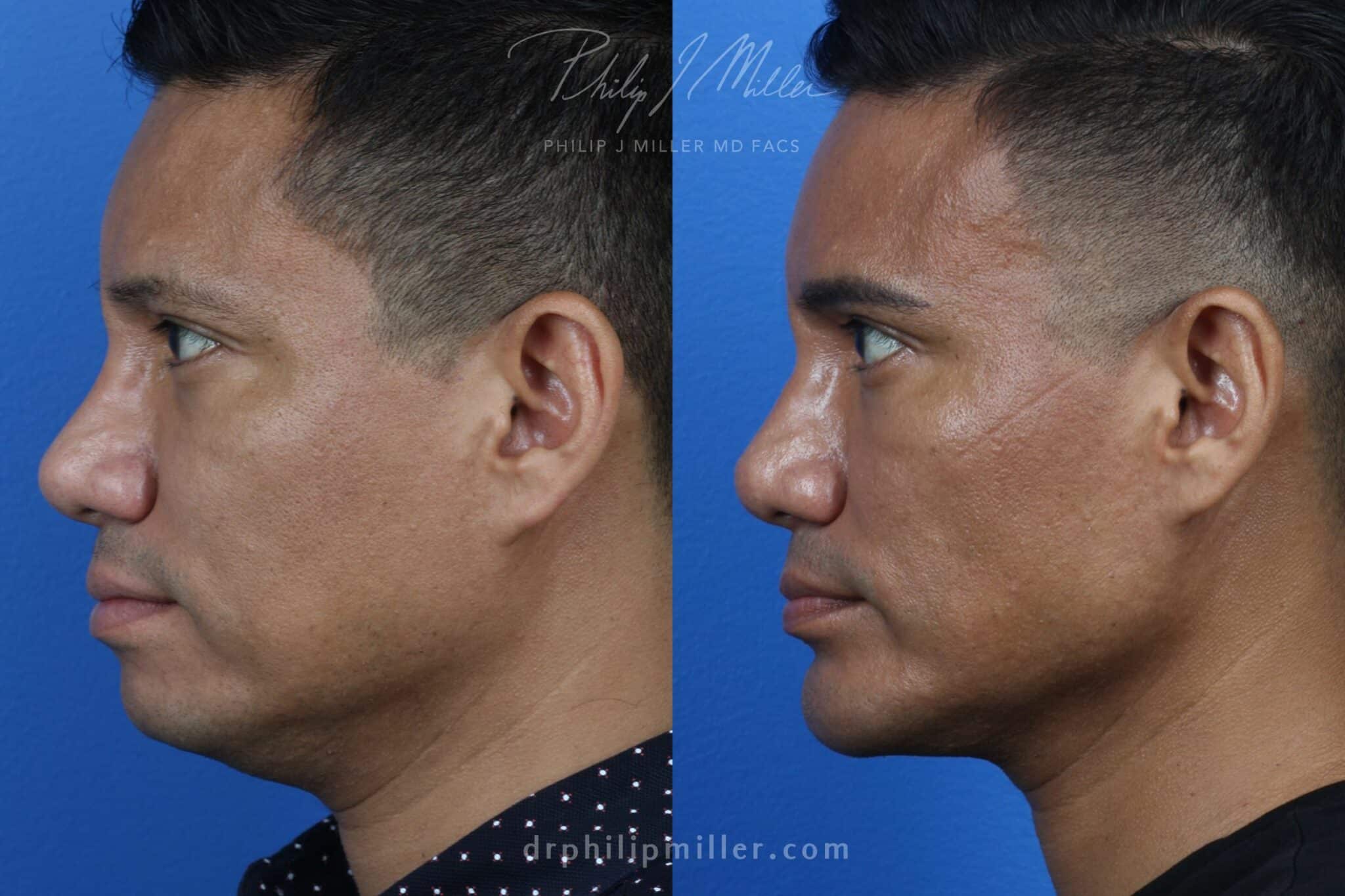 neck liposuction results on a male patient