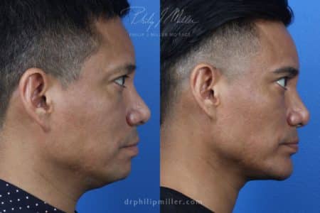 Neck-Tite and Liposuction to Contour the Neck by Dr. Miller