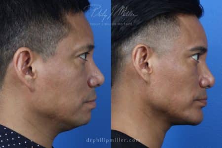 Neck-Tite and Liposuction to Contour the Neck by Dr. Miller