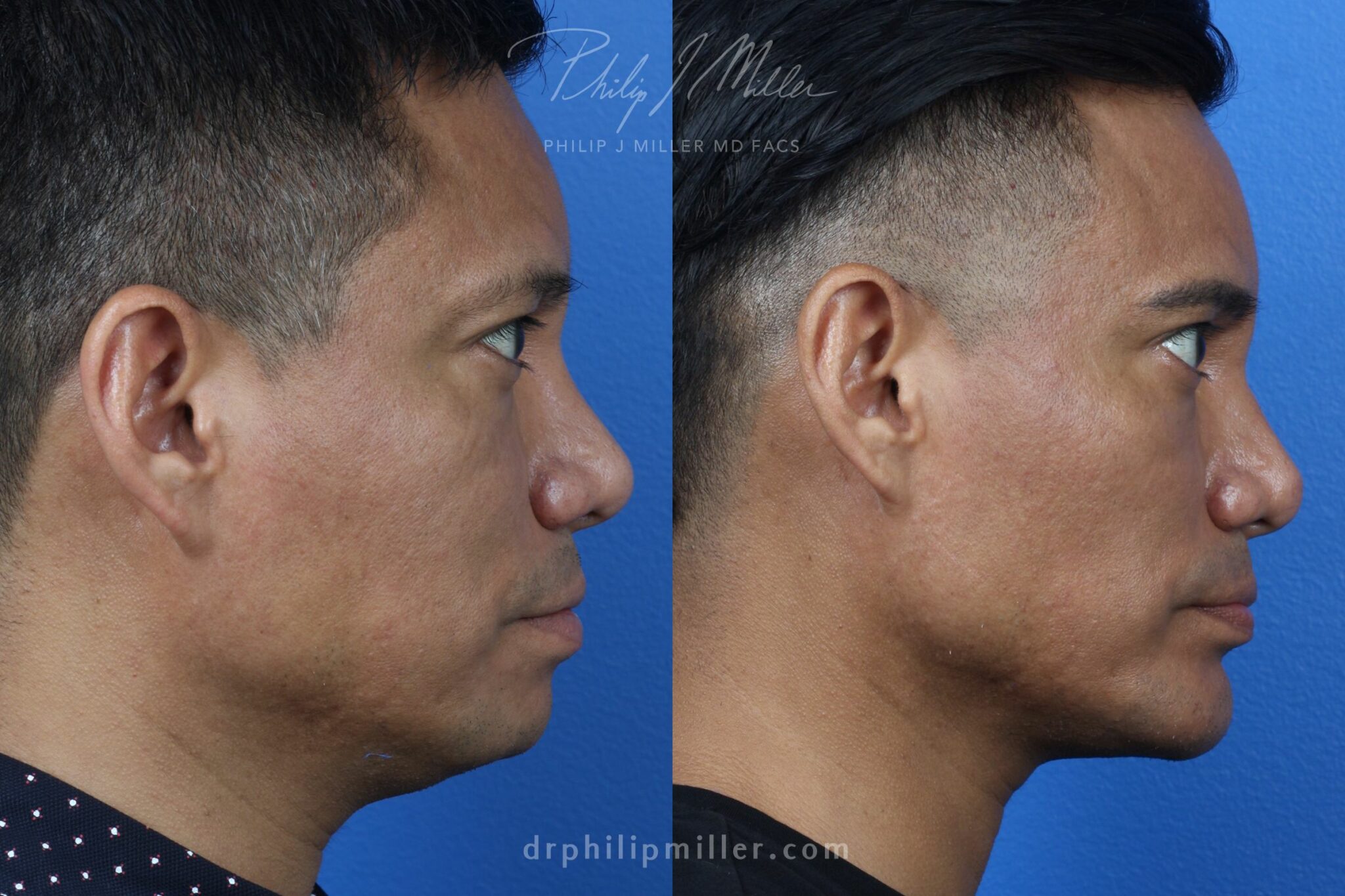 facial liposuction results on a male patient