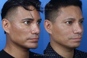 Neck-Tite and liposuction to remove submental fat and sculpt the neck by Dr. Miller. Surgery creates a more defined jawline and improves the facial profile.