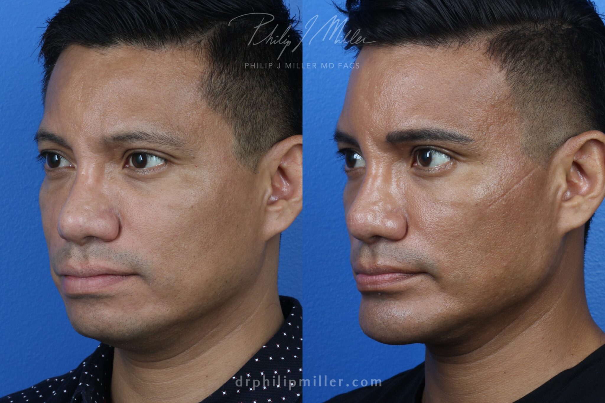 Neck-Tite and liposuction to remove submental fat and sculpt the neck by Dr. Miller. Surgery creates a more defined jawline and improves the facial profile.