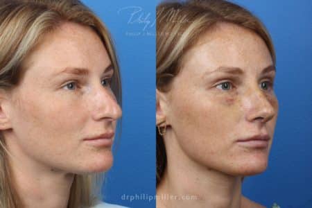 Rhinoplasty to Correct the Nasal Bridge by Dr. Miller