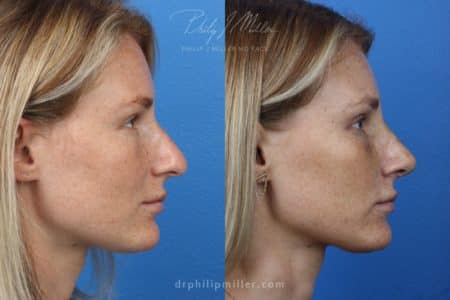 Rhinoplasty to Correct the Nasal Bridge by Dr. Miller