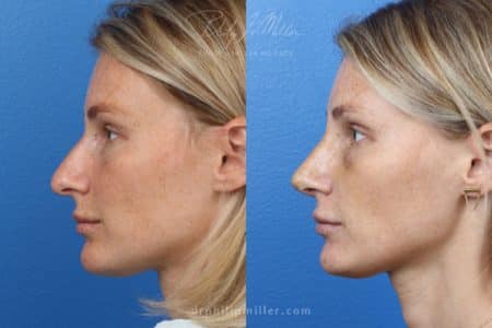 Rhinoplasty to Correct the Nasal Bridge by Dr. Miller