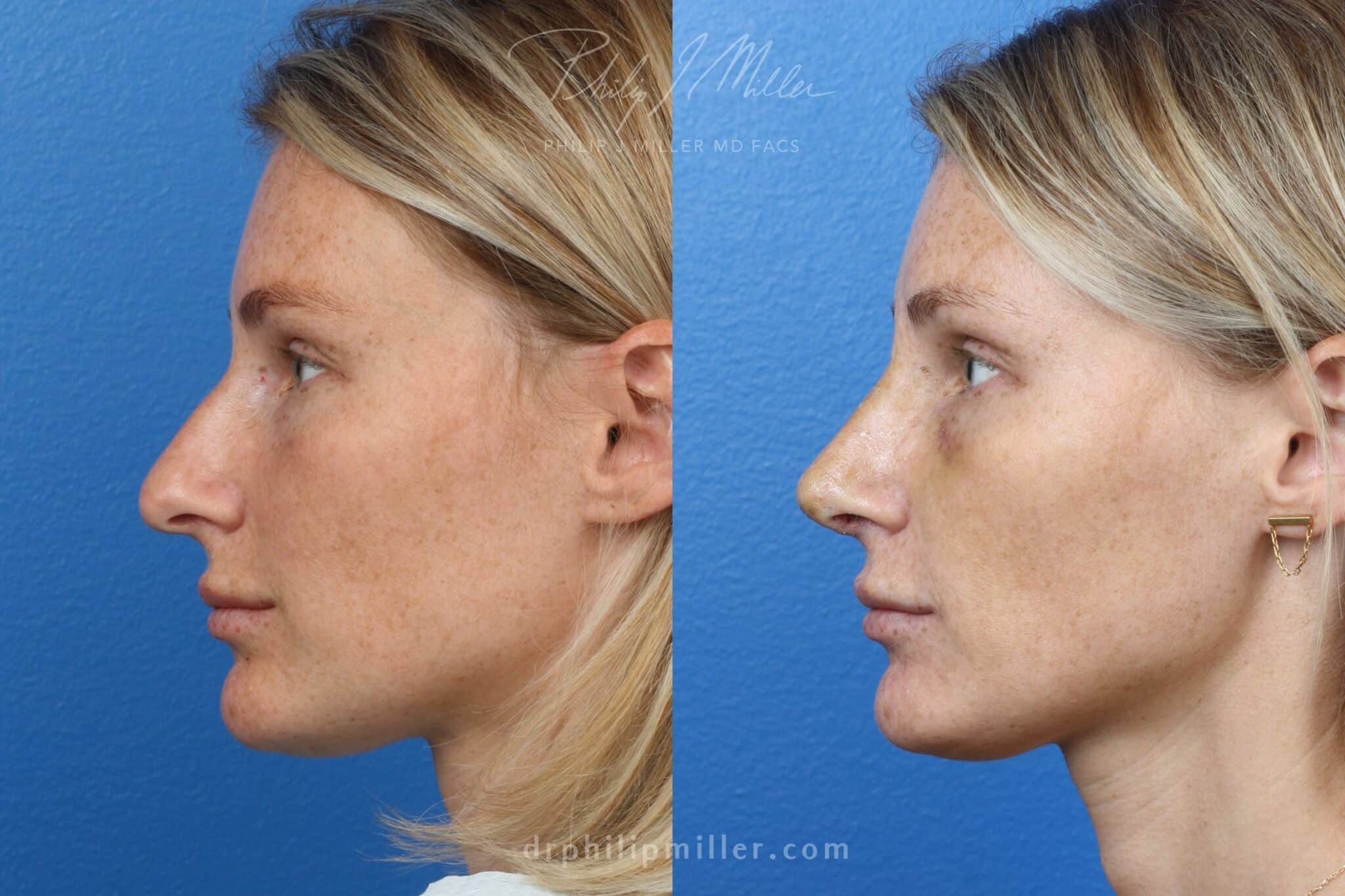 Rhinoplasty to correct the nasal bridge and refine the tip by Dr. Miller. Surgery straightens bridge and rotates tip slightly for an improvement facial profile.