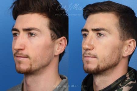 Rhinoplasty to Straighten the Bridge of a Male Patient by Dr. Miller