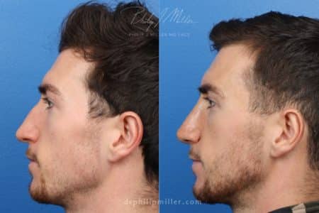 Rhinoplasty to Straighten the Bridge of a Male Patient by Dr. Miller