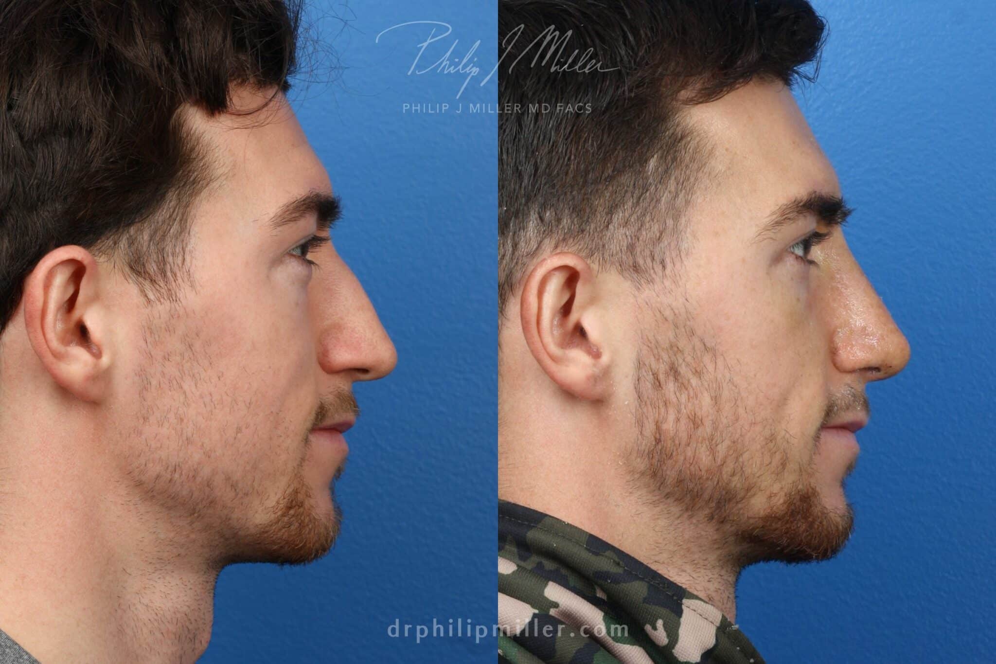 Rhinoplasty to eliminate hump and straighten nasal bridge by Dr. Miller. After surgery, nasal bridge is straighter and facial profile is improved.