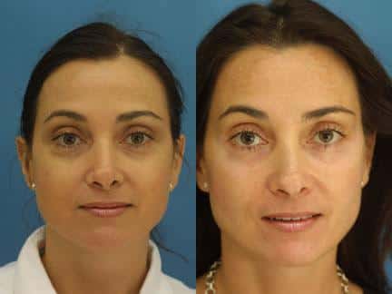 eyelid surgery before and after in new york