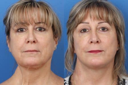 facelift before and after in new york