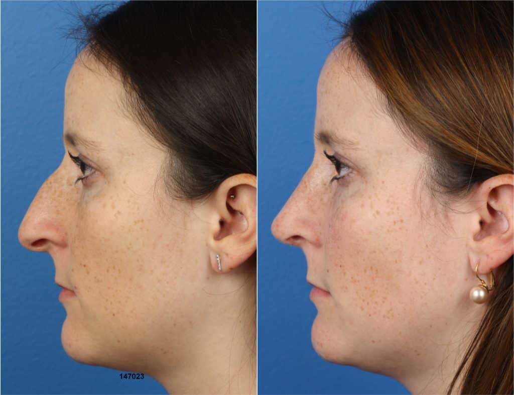 How to Make Your Face Less Flat? 6 Surgical and Non-surgical Options -  Philip Miller MD