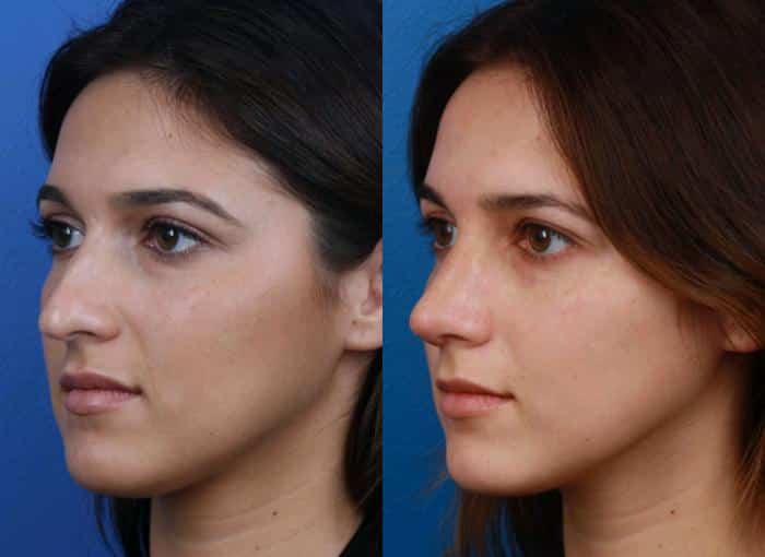 Before and After of a rhinoplasty patient who underwent surgery in Dr. Philip Miller's facial plastic surgery office in New York